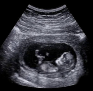 Pregnancy Scans Dublin | Ultrascan