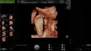 3d baby scan