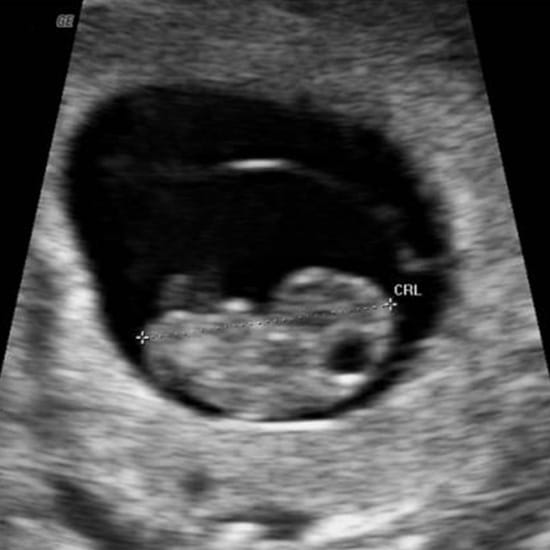early pregnancy scan dublin